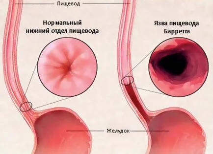 Киселина регургитация, включително след хранене причини и лечение