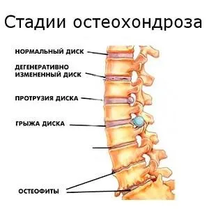 Защо боли кръста при жените причини, лечение