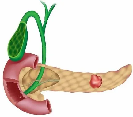 Diareea, pancreatită ca o oprire și pentru a preveni