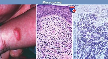 Причините и механизмите на развитие на мастоцитоза
