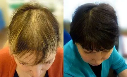 Okai és kezelése androgén alopecia a nők és férfiak
