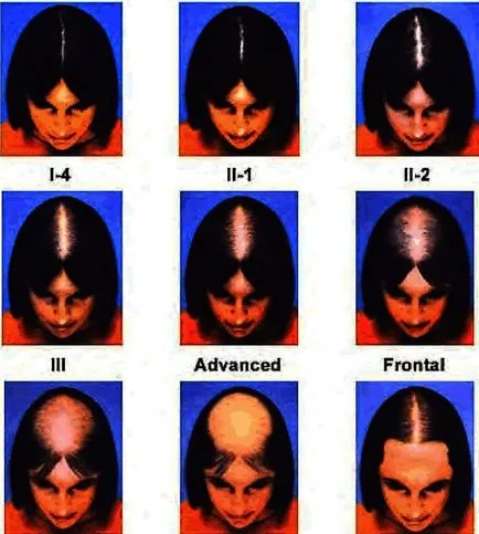 Okai és kezelése androgén alopecia a nők és férfiak