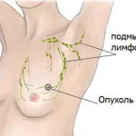 рак на гръдната кост при жени подписва 1, 2, 3, 4 етапа, снимка