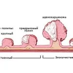 рак на гръдната кост при жени подписва 1, 2, 3, 4 етапа, снимка