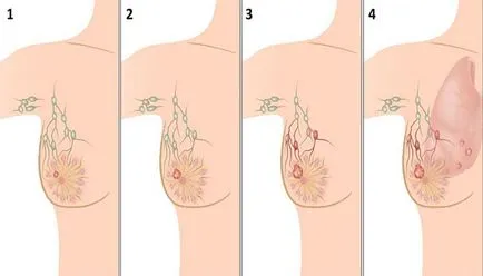 рак на гърдата като бързо разработване, етап и третиране