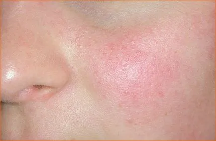 Értágulat vagy rosacea, krasa4you