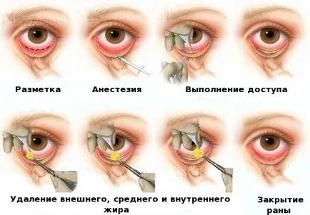 Reabilitarea după o blefaroplastie a pleoapelor superioare și inferioare