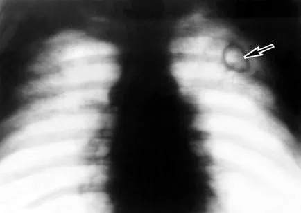 Рентгеново изследване за туберкулоза изглежда като описание и снимки