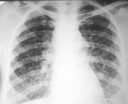 Radiografia toracica pentru tuberculoza arata ca poze si descriere