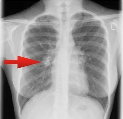 Radiografia toracica pentru tuberculoza arata ca poze si descriere