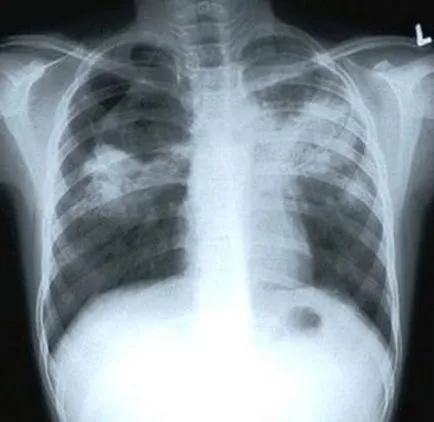 Рентгеново изследване за туберкулоза изглежда като описание и снимки