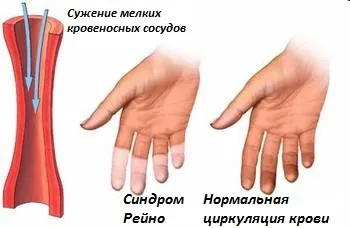 sindromul Raynaud și boala Raynaud sau fenomenul Raynaud, diferențele lor, motivele