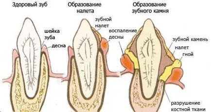 Залитат зъби какво да правя, как да се засили у дома