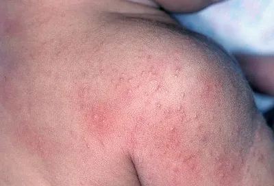 Simptomele urticaria solara si tratament