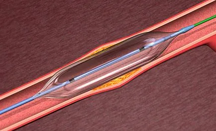 Stand in infarct miocardic - tratament de inima