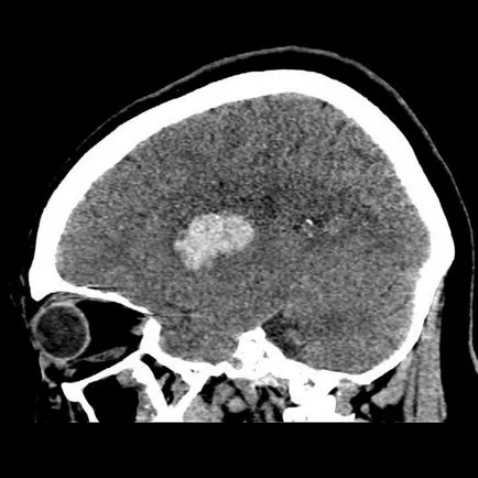 Stem stroke tüneteit, prognózis, kezelés következményei