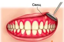 Фистула върху венците на лечението на дете