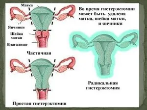 Eltávolítása a méh mióma jelzések műtét, bármilyen módon akkor nagy miómák eltávolítására,