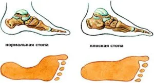 Упражнения за плоски стъпала в деца, юноши и възрастни