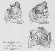 Tipuri de ocluzie, protetica