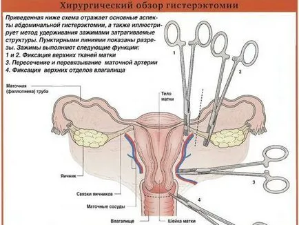 Sebészeti menopauza (klimax) a nők