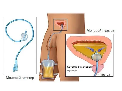 Adenom definiția adenomul de prostata a bolii de prostată, tabloul clinic și