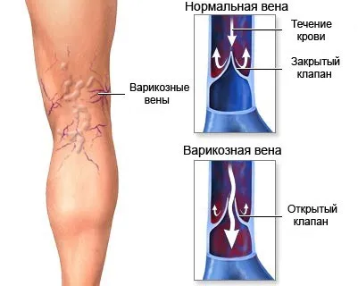 5 метод за защита на разширени вени