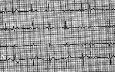 extrasistole atrioventricular (stem extrasistole) - tulburări de formare a pulsului -