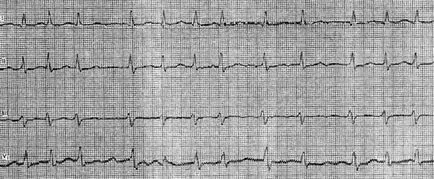 extrasistole atrioventricular (stem extrasistole) - tulburări de formare a pulsului -