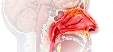 Атрофичен ринит - лечение и профилактика на заболявания