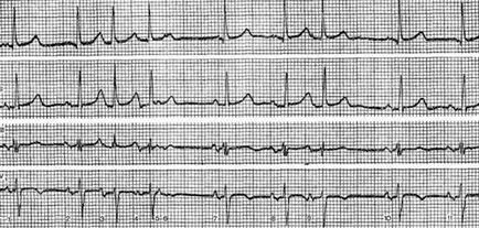 extrasistole atrioventricular (stem extrasistole) - tulburări de formare a pulsului -