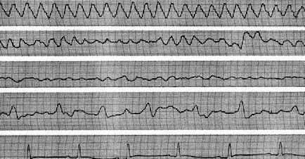 extrasistole atrioventricular (stem extrasistole) - tulburări de formare a pulsului -