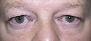 Blepharochalasis око - лечение, фото