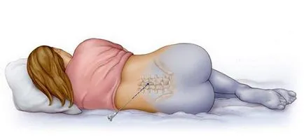 Dureri de spate după anestezie epidurală, ce să facă