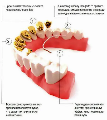 Nadrágtartók «inkognitóban» - diszkrét kezelés