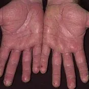Decât pentru a trata eczeme pe maini si picioare