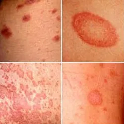 Decât pentru a trata impetigo la om (roz, Tinea, pitiriazis, pecingine, etc.