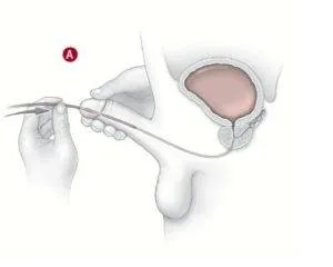 опасно аденом на простатата и как да се отрази на потентността при мъжете, изпускане на урина през тръбата при аденом
