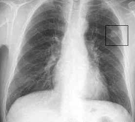 Което показва рентгенова снимка на белите дробове компетентен декодиране рентгенов светлинни