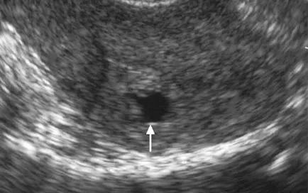 Mi adenomyosis hogyan kezelje tüneteit