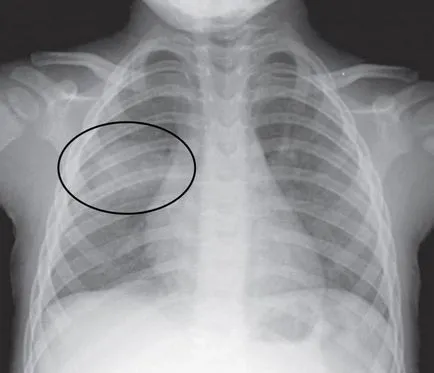Което показва рентгенова снимка на белите дробове компетентен декодиране рентгенов светлинни