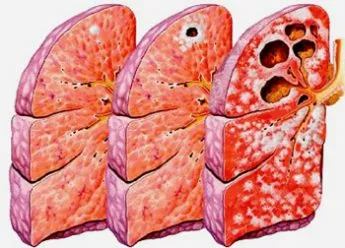 Цироза белодробна туберкулоза какво е, симптоми и лечението