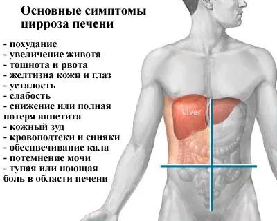 Цироза на черния дроб, на снимката и нейното лечение