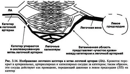 Право предсърдно налягане