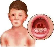 Детство инфекции - скарлатина