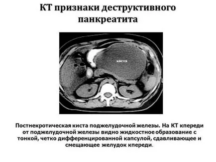 A destruktív pancreatitis mi ez, és hogyan kell kezelni pancreatitis