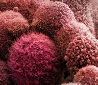 Jóindulatú daganatok a hasnyálmirigy és a tünetek a kezelés