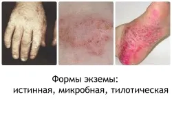 Eczeme privind cauzele picior, simptome și tratament