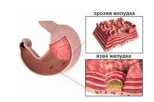 Gastrita eroziv - Simptome, cauze, tratament