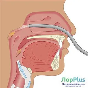 Endoscopy ENT betegségek a klinikán - ENT plus perm